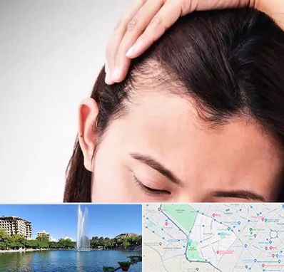 کاشت مو بانوان در کوهسنگی مشهد