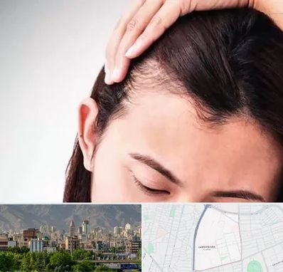 کاشت مو بانوان در جمشیدیه