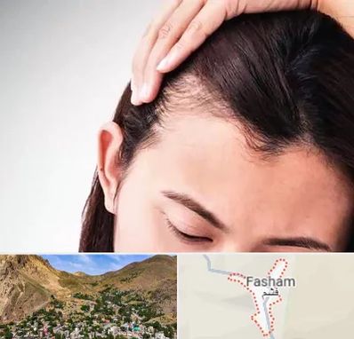 کاشت مو بانوان در فشم