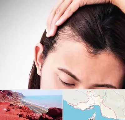 کاشت مو بانوان در هرمزگان
