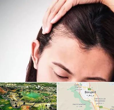 کاشت مو بانوان در بروجرد