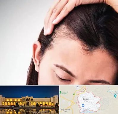 کاشت مو بانوان در برازجان