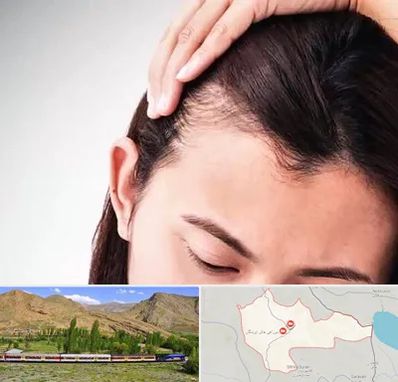 کاشت مو بانوان در خاش