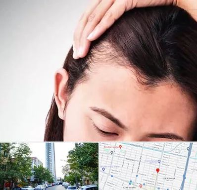 کاشت مو بانوان در امامت مشهد