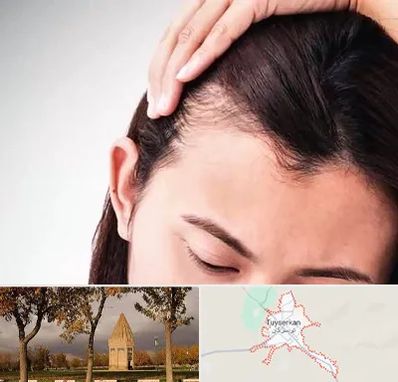کاشت مو بانوان در تویسرکان