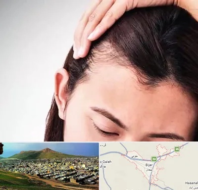 کاشت مو بانوان در بیجار