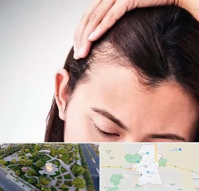 کاشت مو بانوان در کاشمر