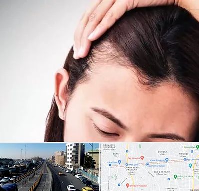 کاشت مو بانوان در پیروزی 