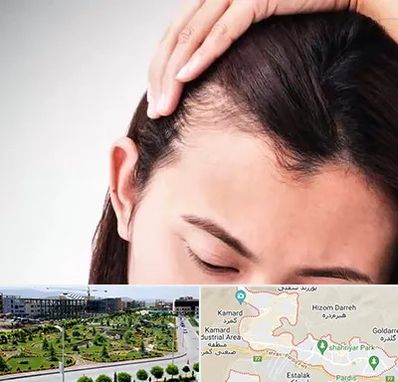 کاشت مو بانوان در پردیس