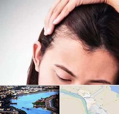 کاشت مو بانوان در خرمشهر