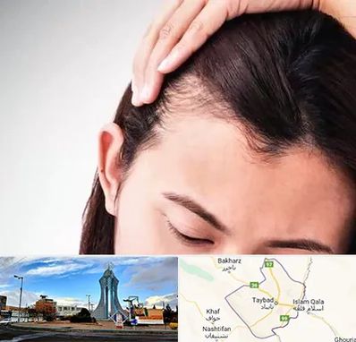 کاشت مو بانوان در تایباد