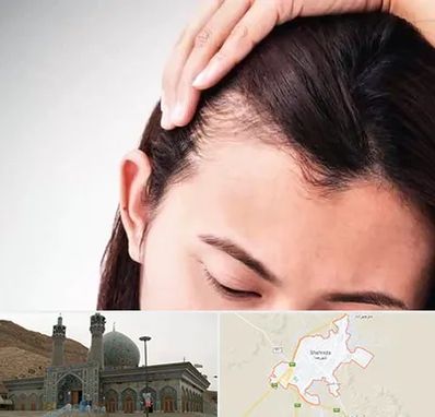 کاشت مو بانوان در شهرضا