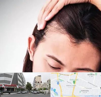 کاشت مو بانوان در بلوار فردوس 