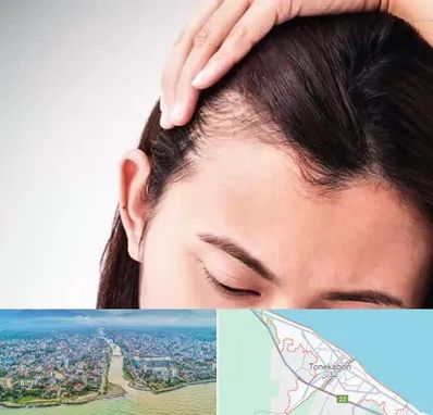 کاشت مو بانوان در تنکابن