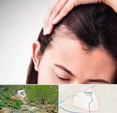 کاشت مو بانوان در کردان