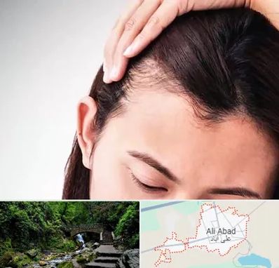 کاشت مو بانوان در علی‌ آباد کتول