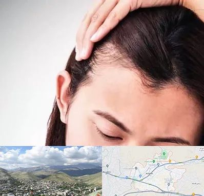 کاشت مو بانوان در رودهن