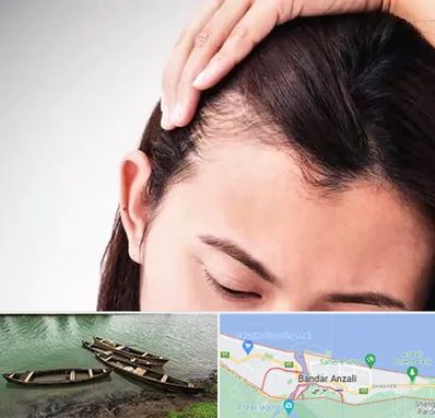 کاشت مو بانوان در بندر انزلی