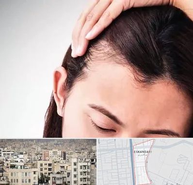 کاشت مو بانوان در اسکندری