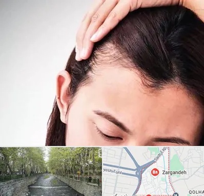 کاشت مو بانوان در زرگنده