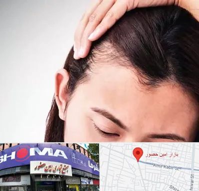 کاشت مو بانوان در امین حضور