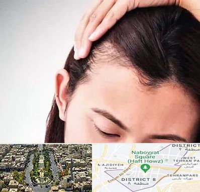 کاشت مو بانوان در نارمک 