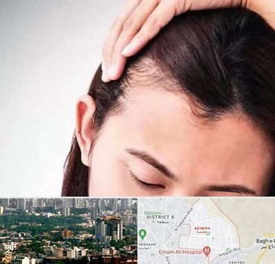 کاشت مو بانوان در عظیمیه کرج 