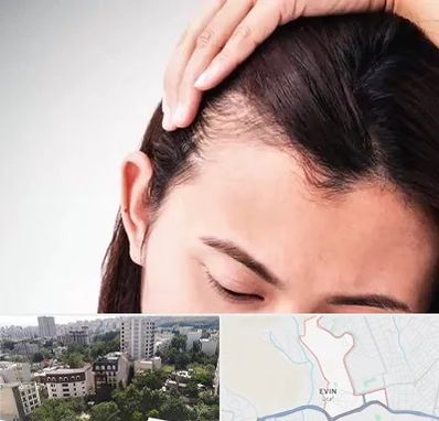 کاشت مو بانوان در اوین