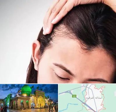 کاشت مو بانوان در آستانه اشرفیه