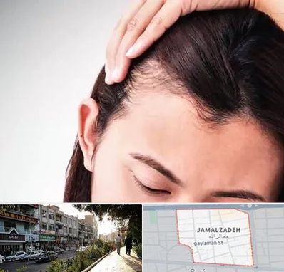 کاشت مو بانوان در خیابان جمالزاده