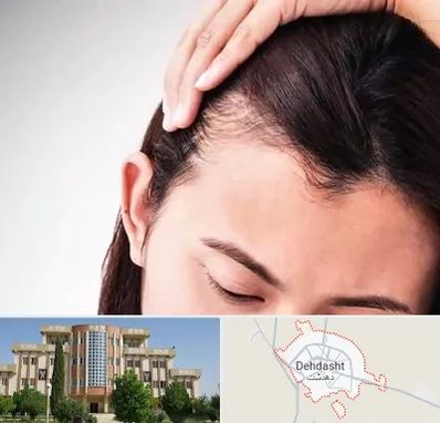 کاشت مو بانوان در دهدشت