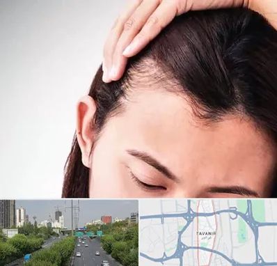 کاشت مو بانوان در توانیر