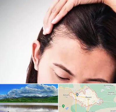 کاشت مو بانوان در مرند