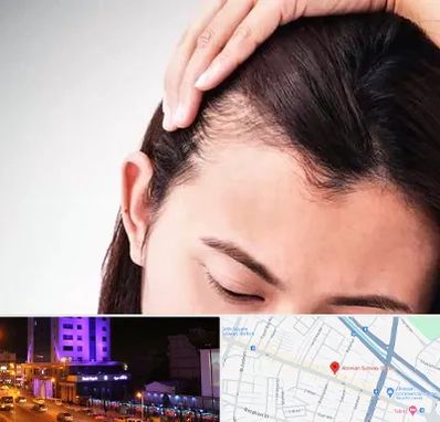 کاشت مو بانوان در آبرسان تبریز