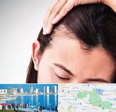 کاشت مو بانوان در چیتگر