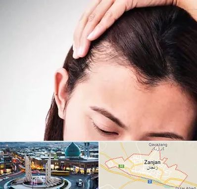 کاشت مو بانوان در زنجان