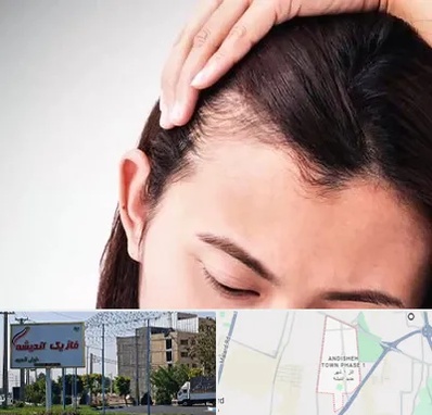 کاشت مو بانوان در فاز یک اندیشه