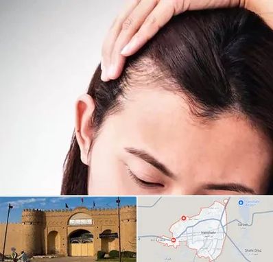 کاشت مو بانوان در ایرانشهر