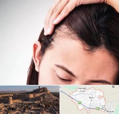 کاشت مو بانوان در بم
