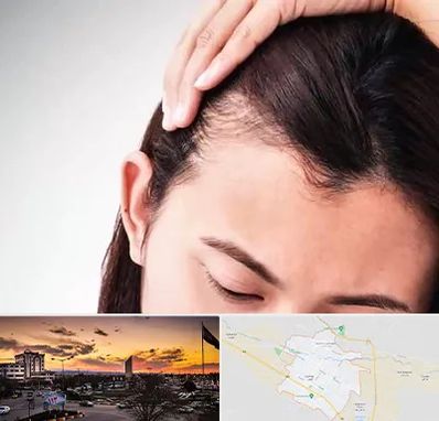 کاشت مو بانوان در قوچان