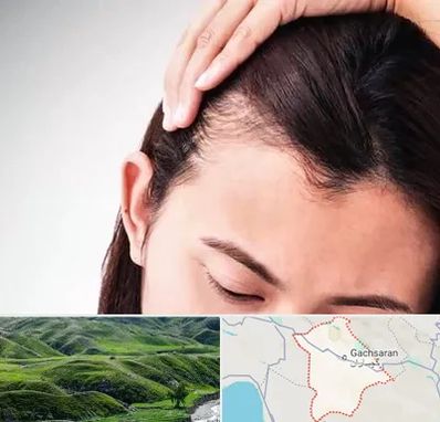 کاشت مو بانوان در گچساران