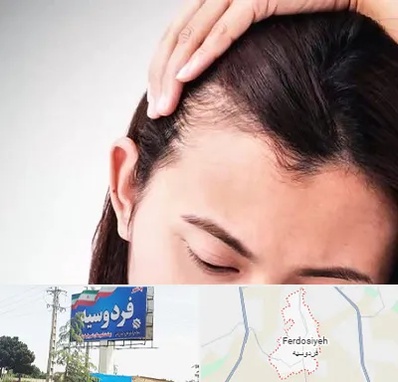 کاشت مو بانوان در فردوسیه شهریار