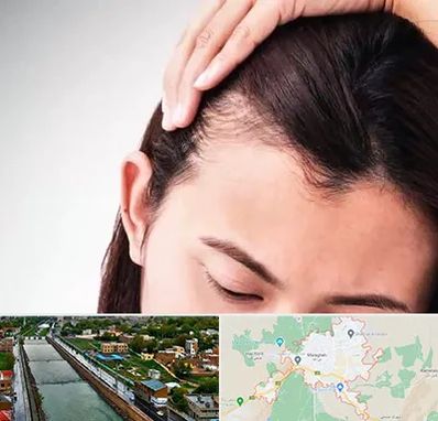 کاشت مو بانوان در مراغه