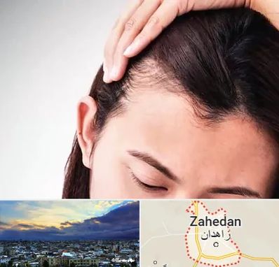 کاشت مو بانوان در زاهدان