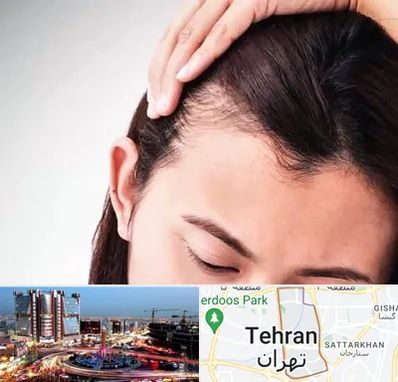 کاشت مو بانوان در صادقیه 