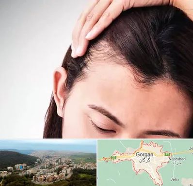 کاشت مو بانوان در گرگان