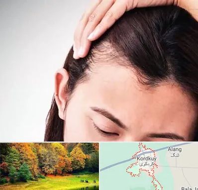 کاشت مو بانوان در کردکوی