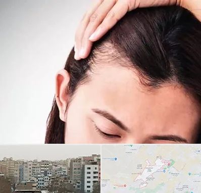 کاشت مو بانوان در محمد شهر کرج 