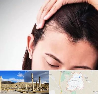 کاشت مو بانوان در مرودشت