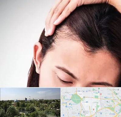 کاشت مو بانوان در منطقه 16 تهران 